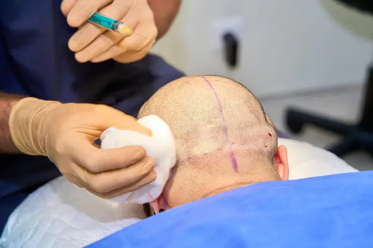 Hair Transplant at DrHairs: