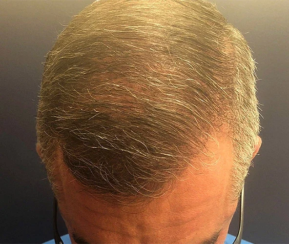 Balance-Hair-Restoration-Results-FUE-2